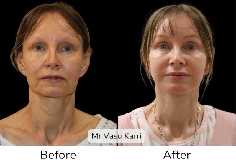 Facelift Patient 16 View 1